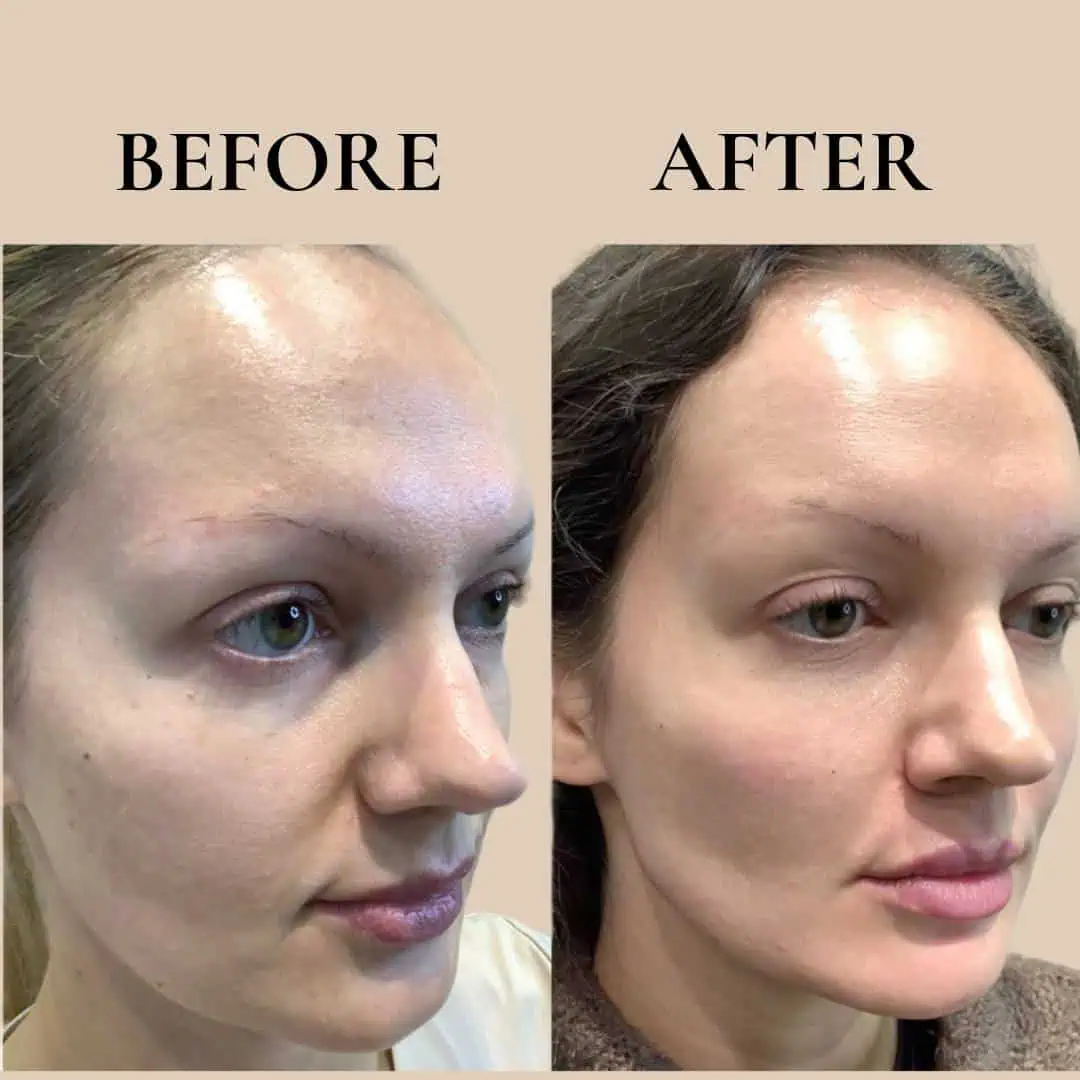 fillers-before-after-eight-eg-aesthetic-service-in-mayfield-heights-oh