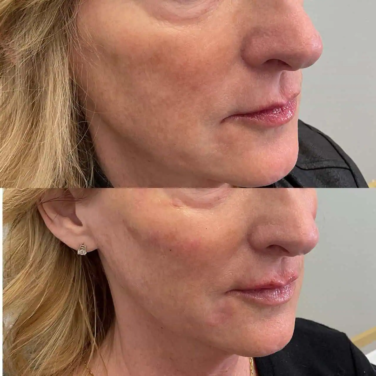 fillers-before-after-eleven-eg-aesthetic-service-in-mayfield-heights-oh