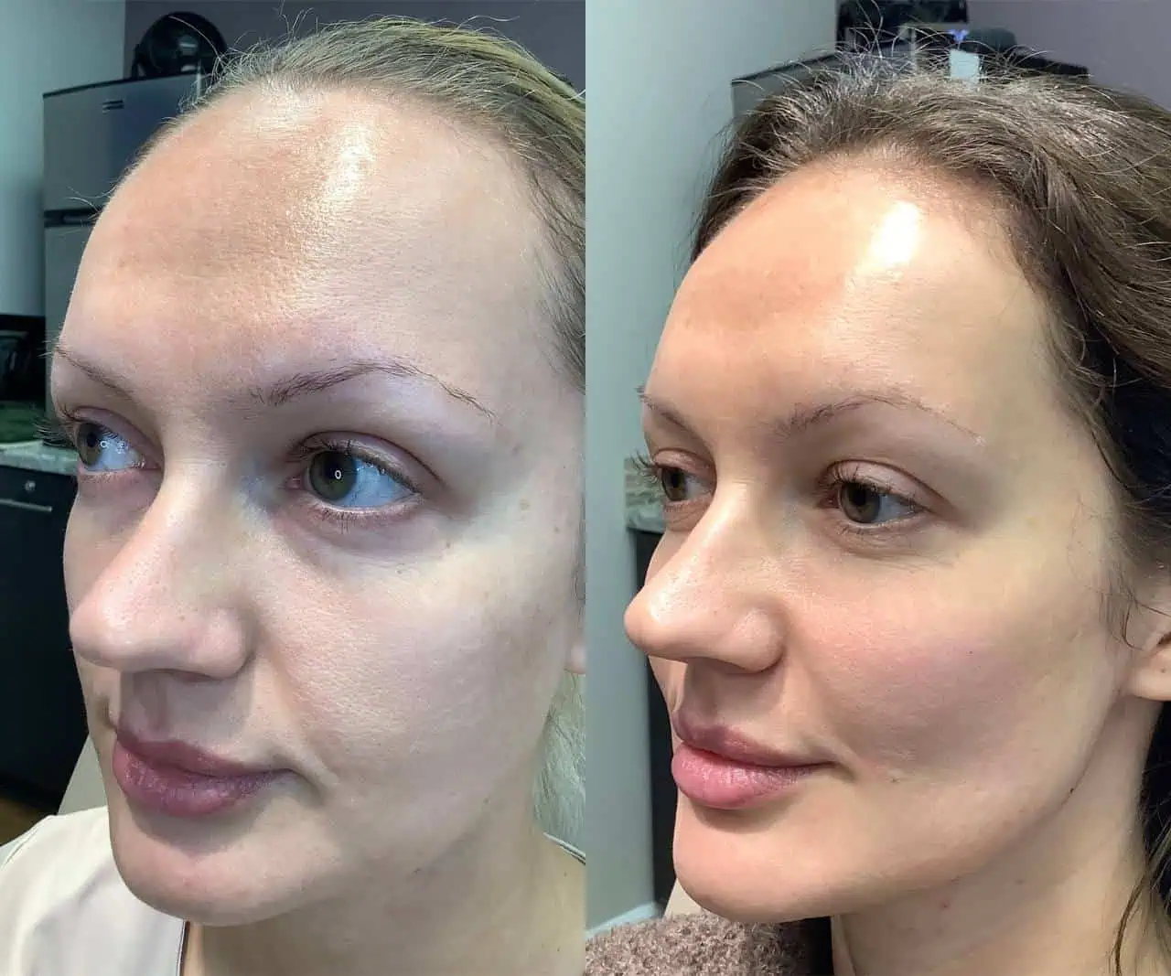 fillers-before-after-five-eg-aesthetic-service-in-mayfield-heights-oh