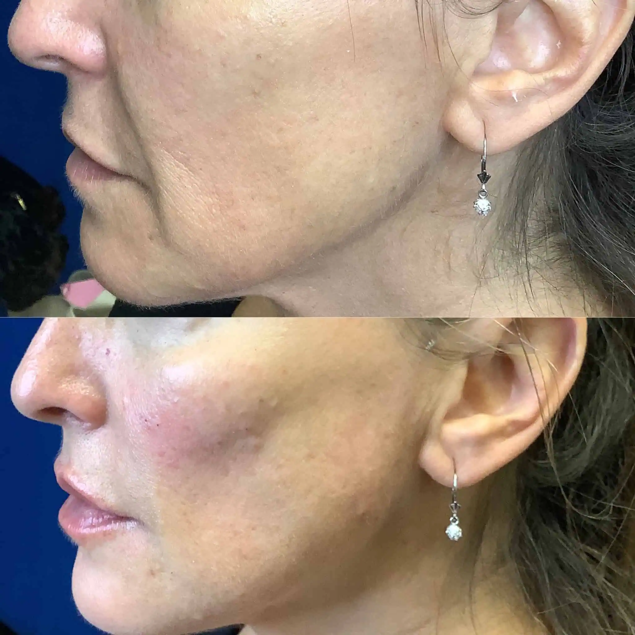 fillers-before-after-four-eg-aesthetic-service-in-mayfield-heights-oh