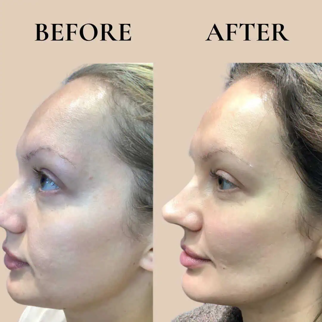 fillers-before-after-nine-eg-aesthetic-service-in-mayfield-heights-oh