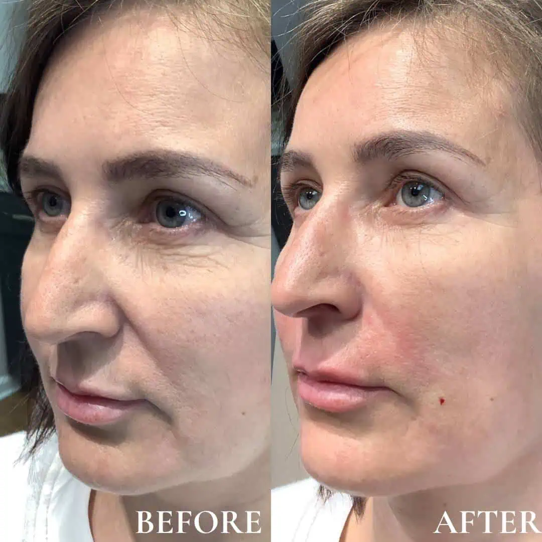 fillers-before-after-seven-eg-aesthetic-service-in-mayfield-heights-oh