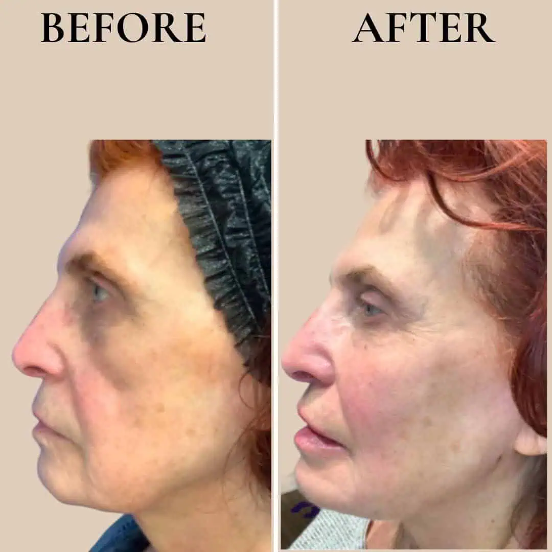 fillers-before-after-six-eg-aesthetic-service-in-mayfield-heights-oh