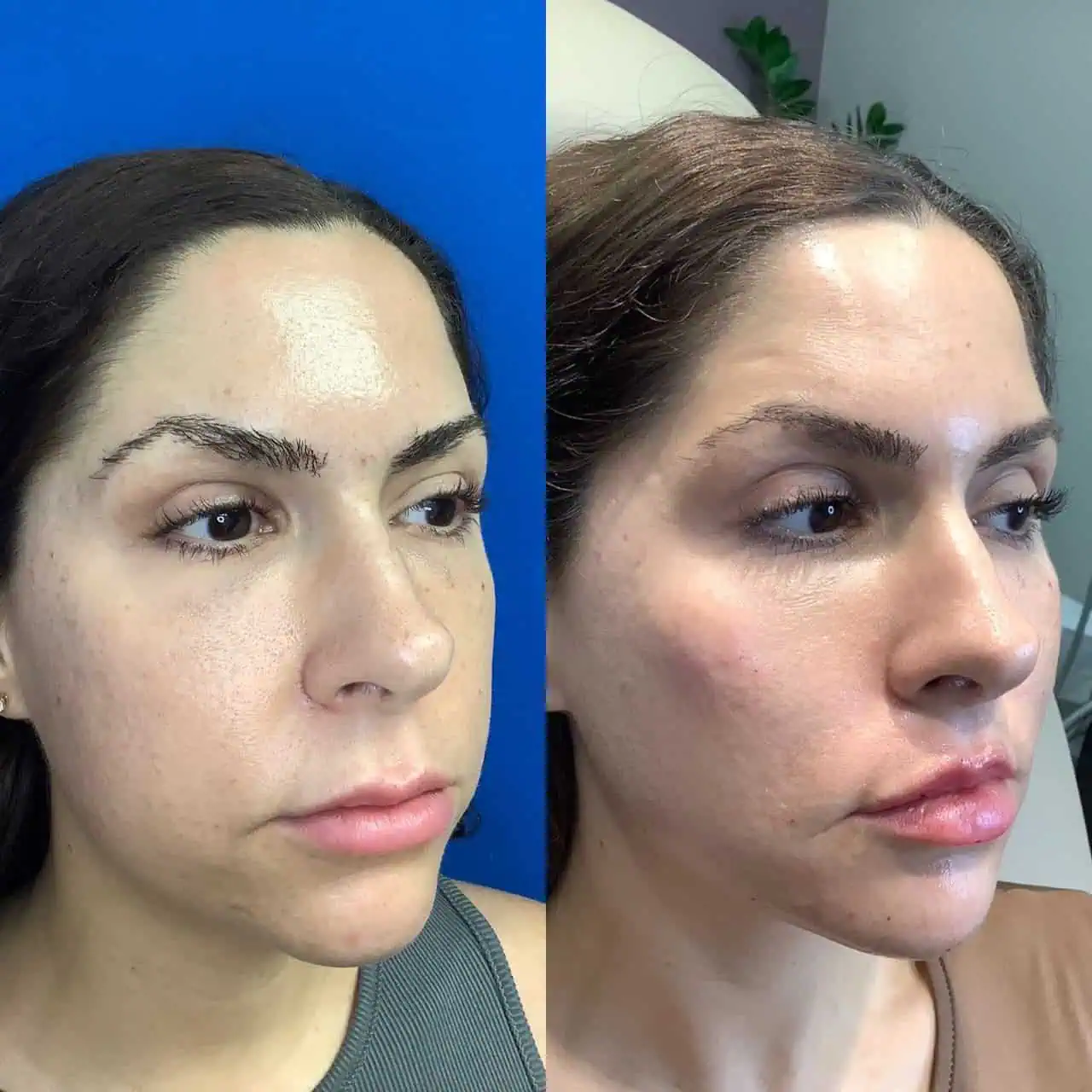 fillers-before-after-ten-eg-aesthetic-service-in-mayfield-heights-oh