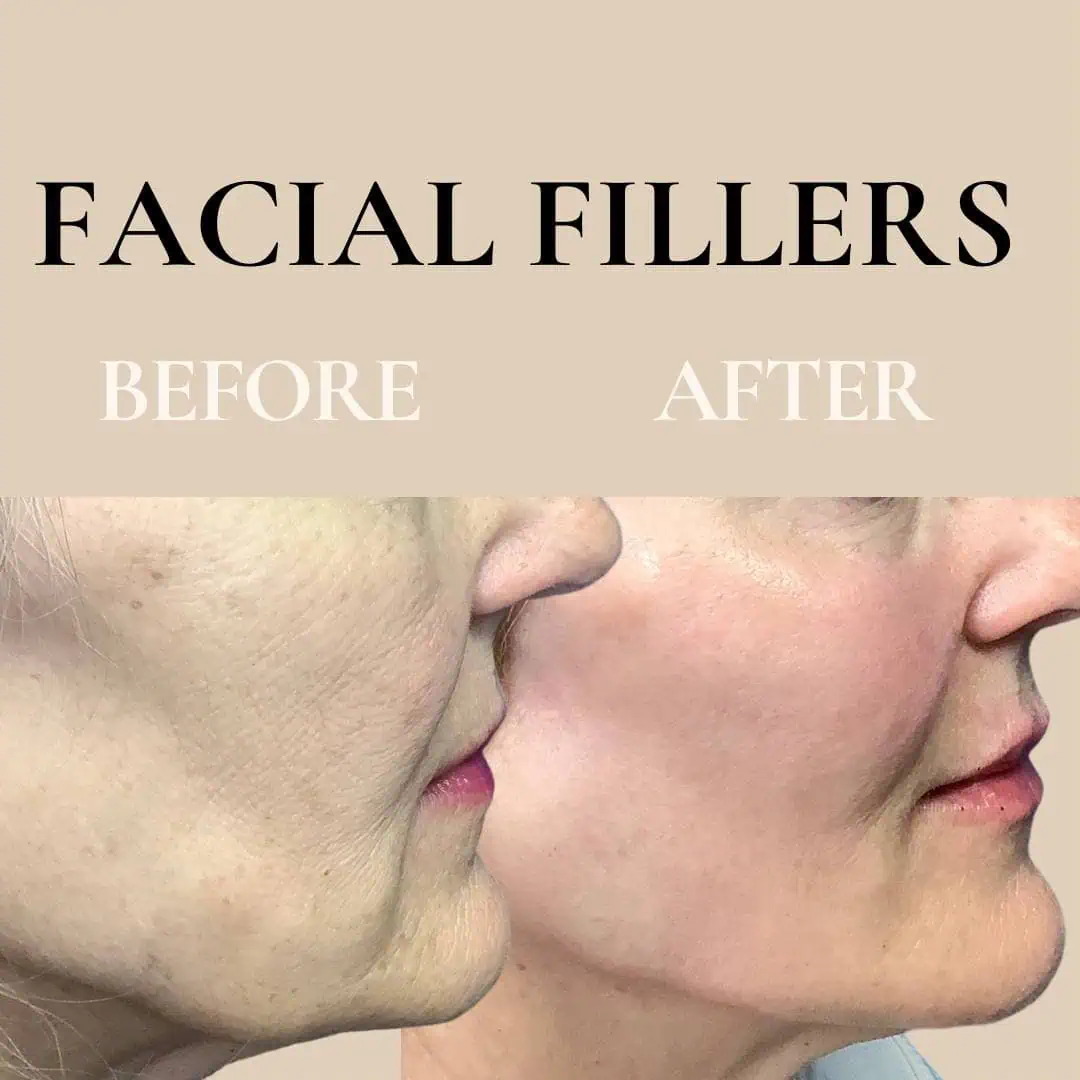 fillers-before-after-three-eg-aesthetic-service-in-mayfield-heights-oh