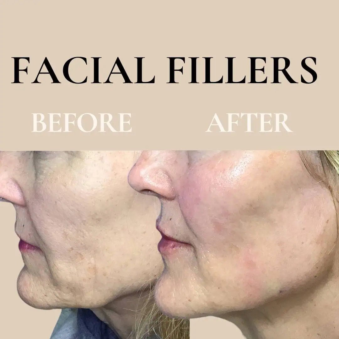 fillers-before-after-two-eg-aesthetic-service-in-mayfield-heights-oh