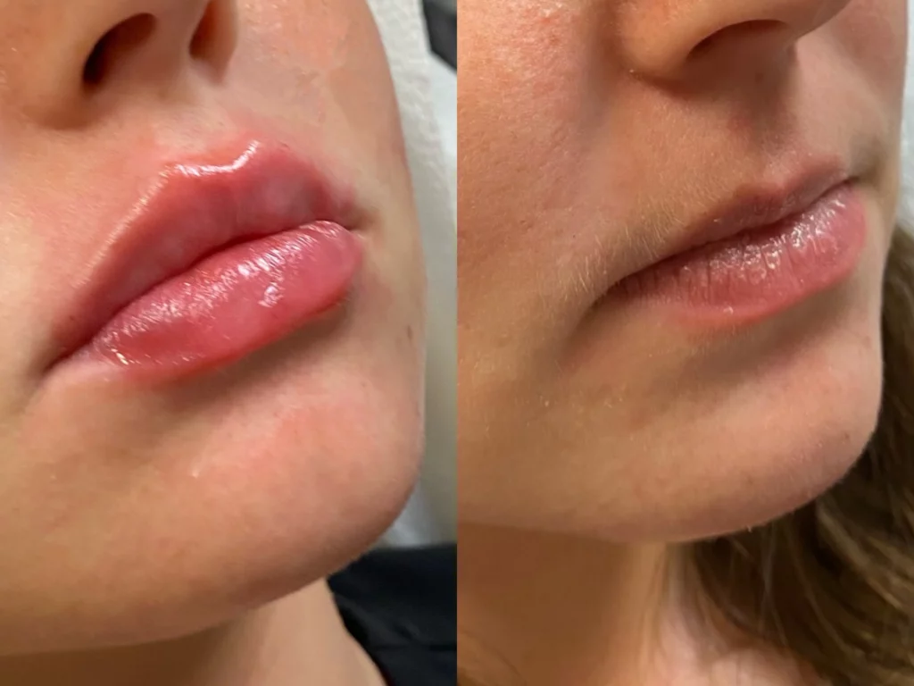 lips before & after