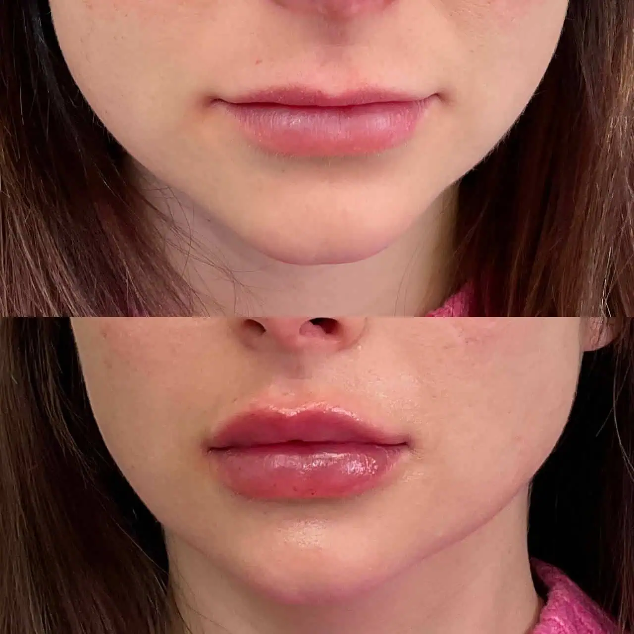 lips-before-after-eight-eg-aesthetic-service-in-mayfield-heights-oh