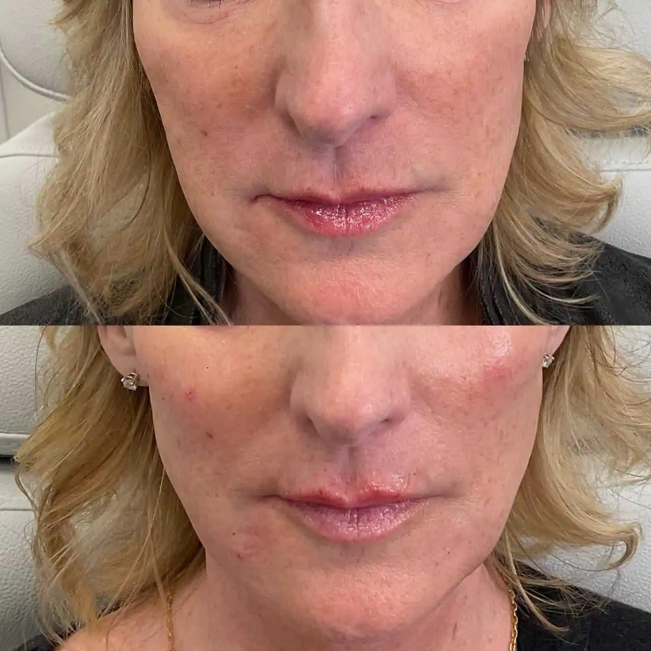 lips-before-after-fifteen-eg-aesthetic-service-in-mayfield-heights-oh