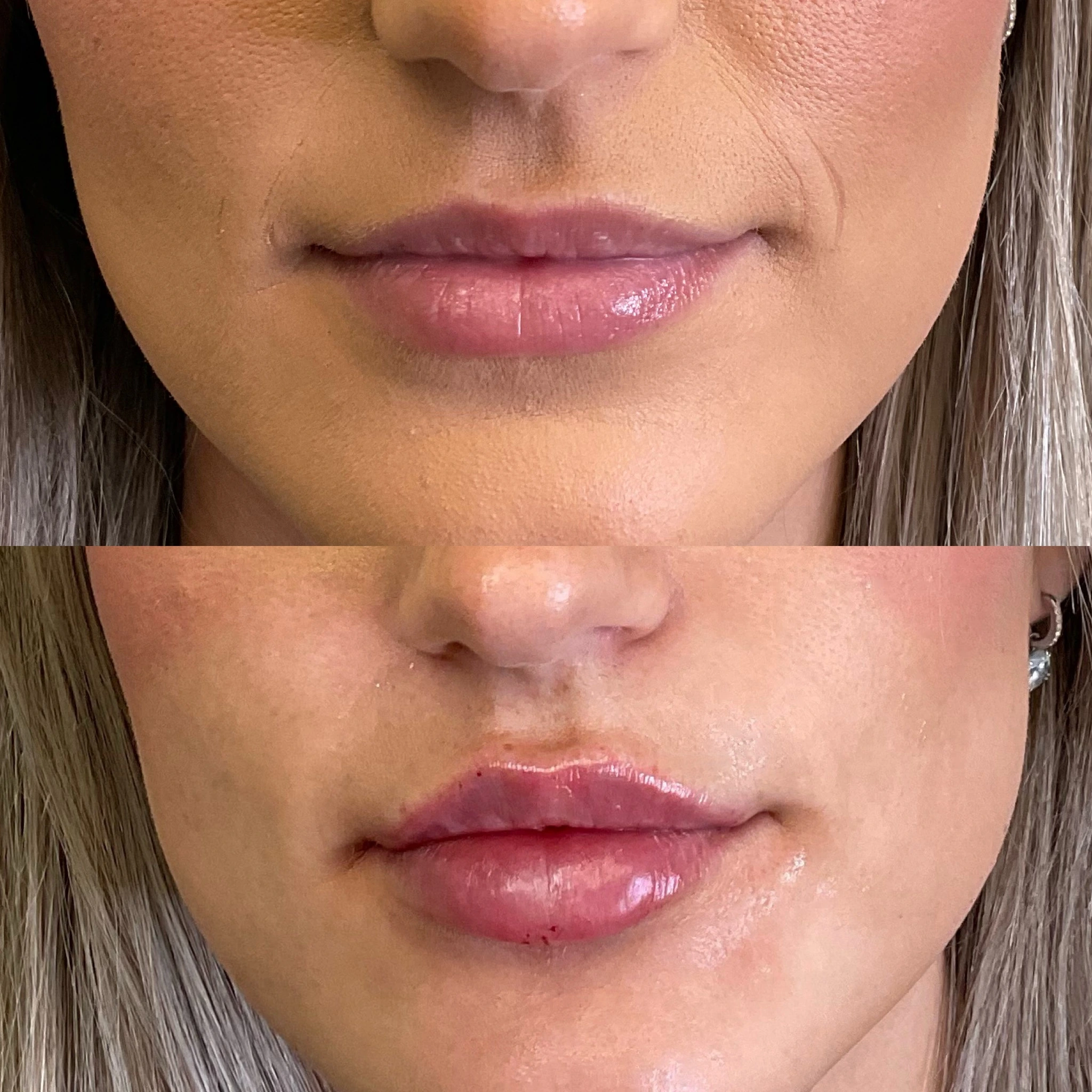 lips-before-after-five-eg-aesthetic-service-in-mayfield-heights-oh