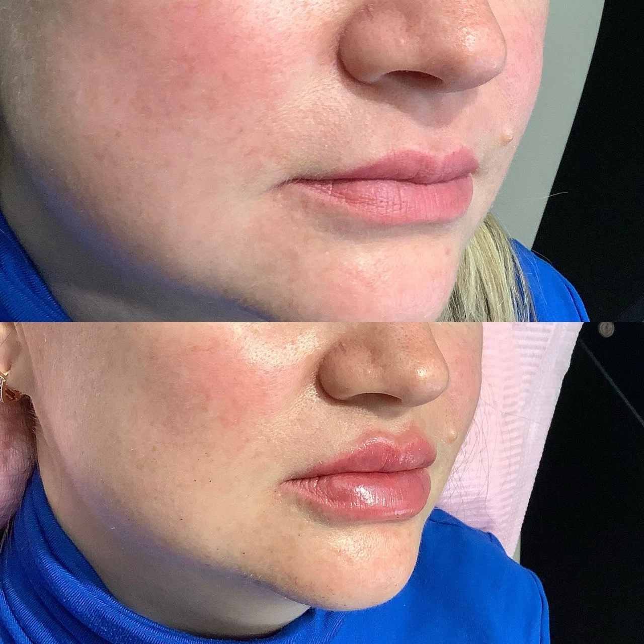 lips-before-after-four-eg-aesthetic-service-in-mayfield-heights-oh