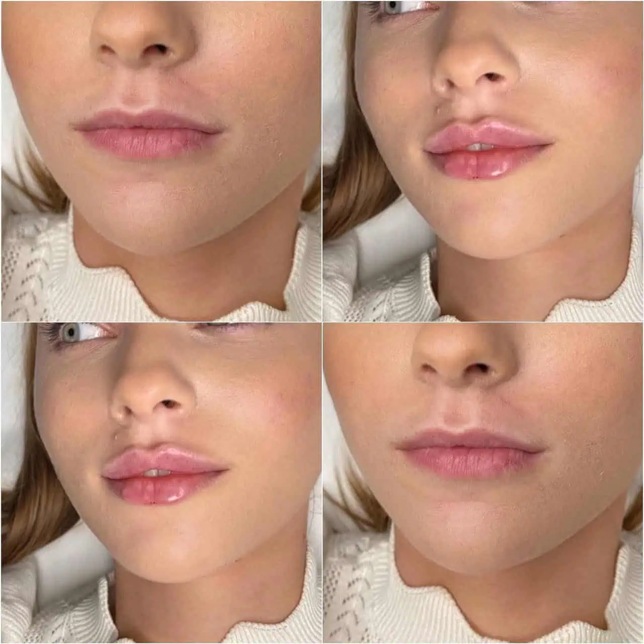 lips-before-after-fourteen-eg-aesthetic-service-in-mayfield-heights-oh