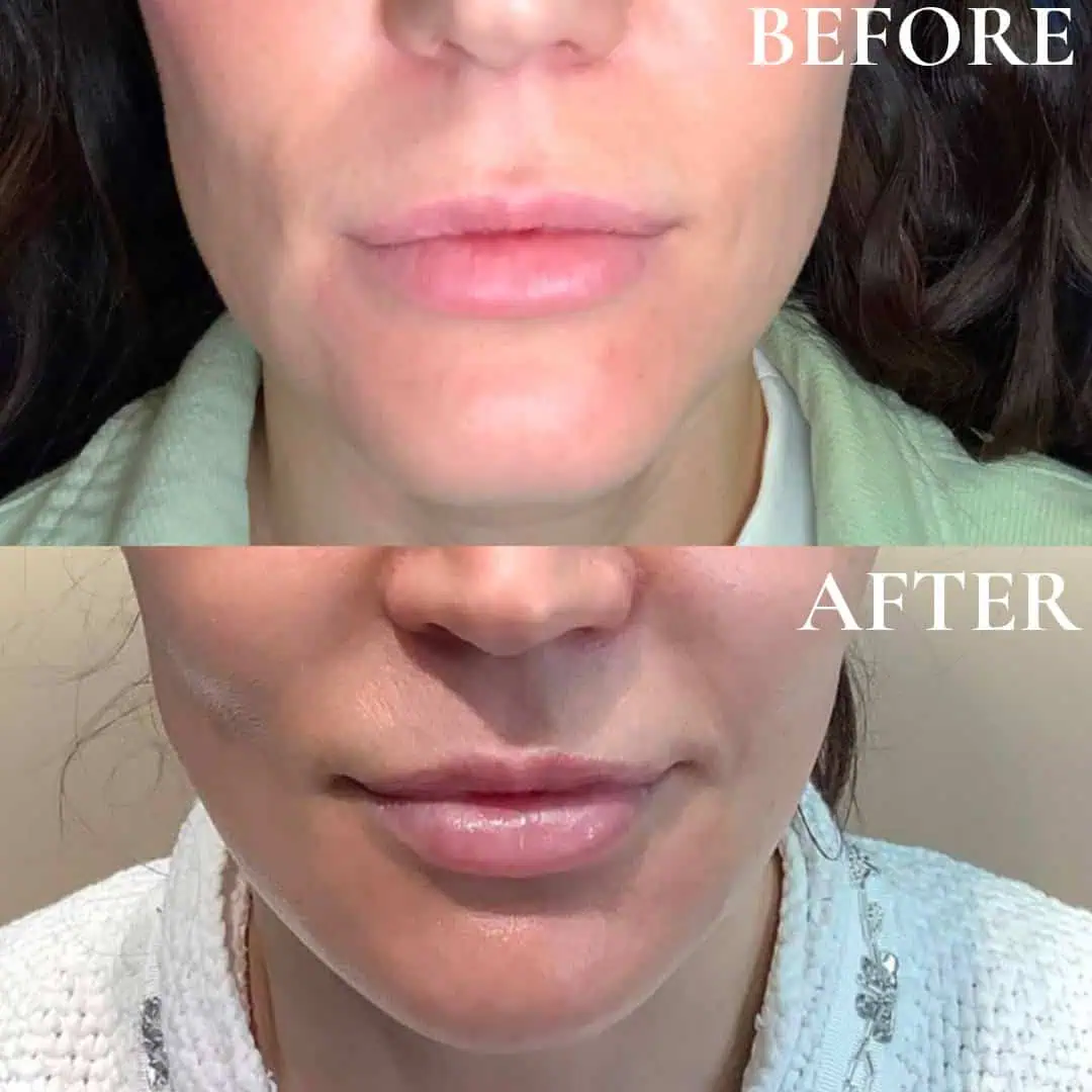 lips-before-after-nine-eg-aesthetic-service-in-mayfield-heights-oh