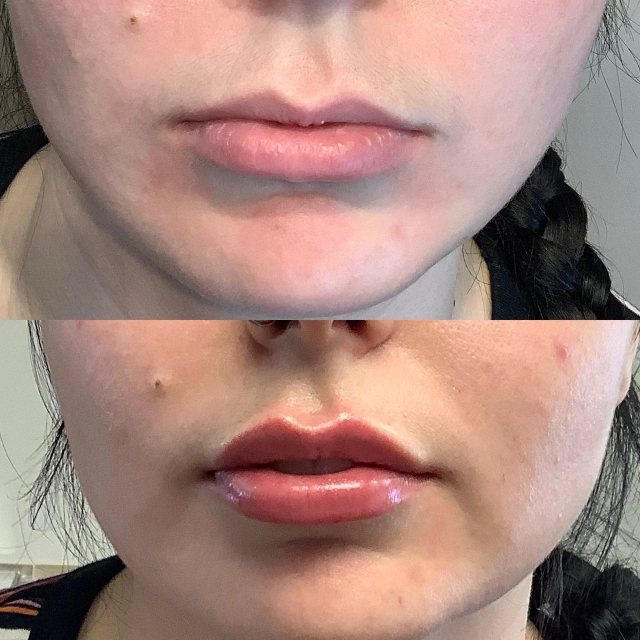 lips-before-after-one-eg-aesthetic-service-in-mayfield-heights-oh