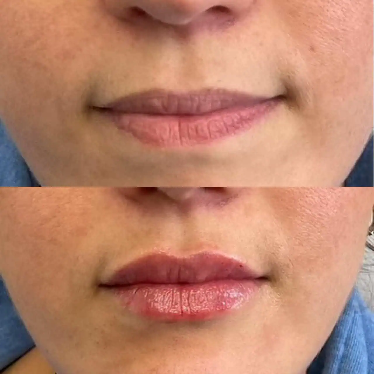 lips-before-after-seven-eg-aesthetic-service-in-mayfield-heights-oh