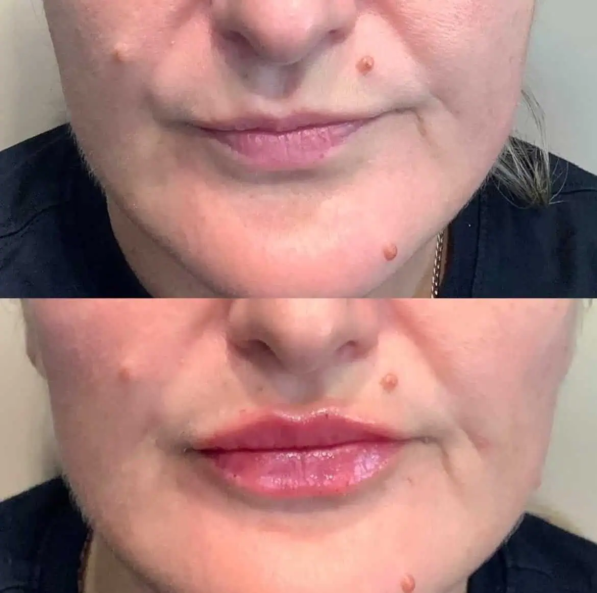 lips-before-after-sixteen-eg-aesthetic-service-in-mayfield-heights-oh