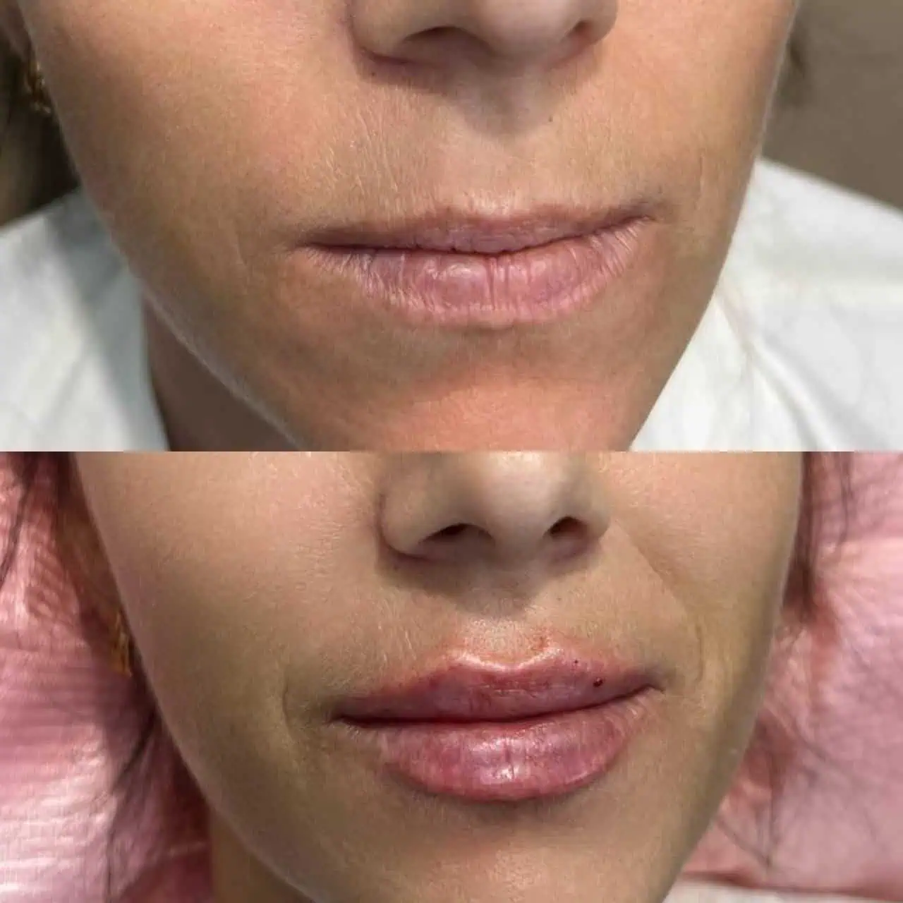 lips-before-after-ten-eg-aesthetic-service-in-mayfield-heights-oh