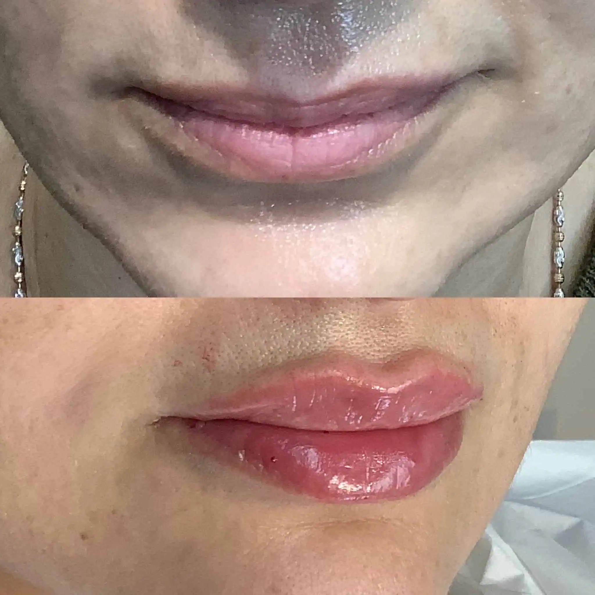 lips-before-after-thirteen-eg-aesthetic-service-in-mayfield-heights-oh