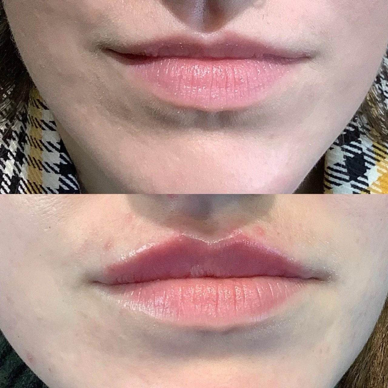 lips-before-after-three-eg-aesthetic-service-in-mayfield-heights-oh