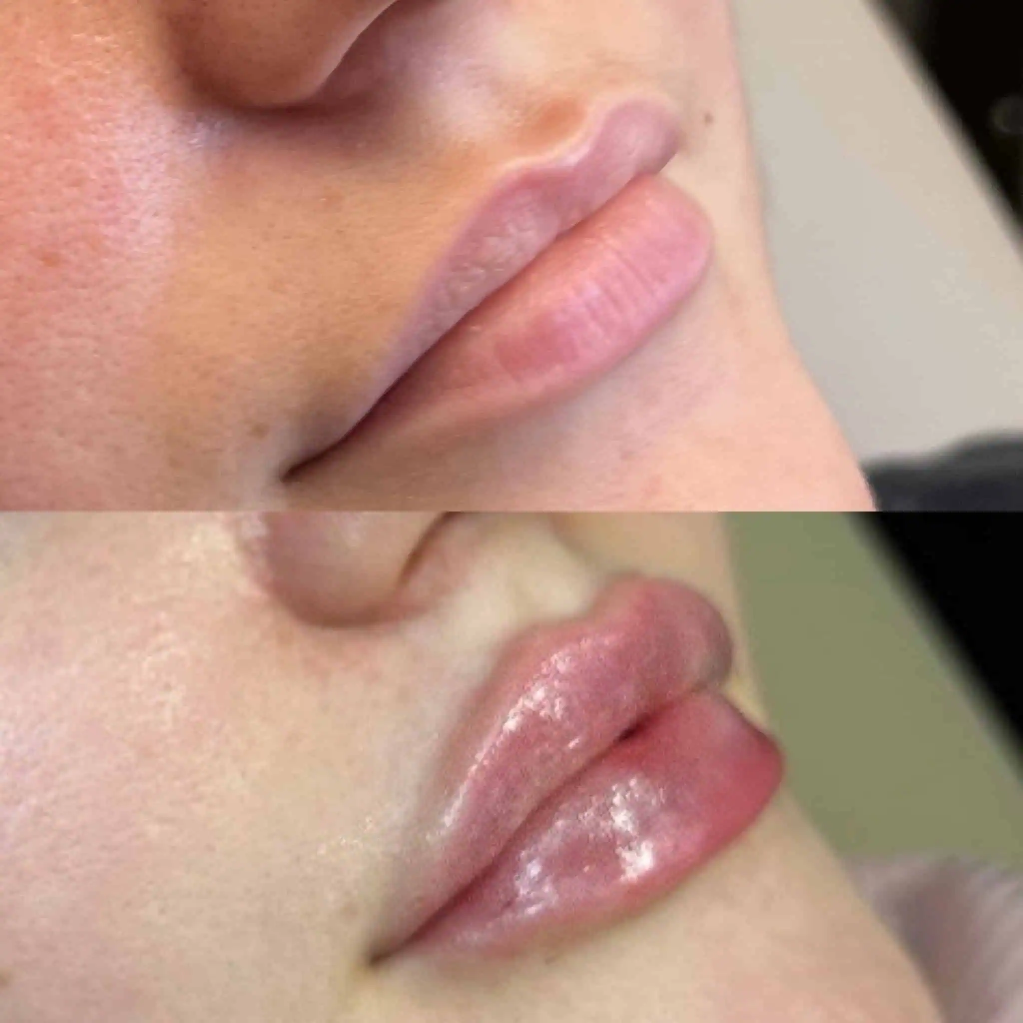 lips-before-after-twelve-eg-aesthetic-service-in-mayfield-heights-oh