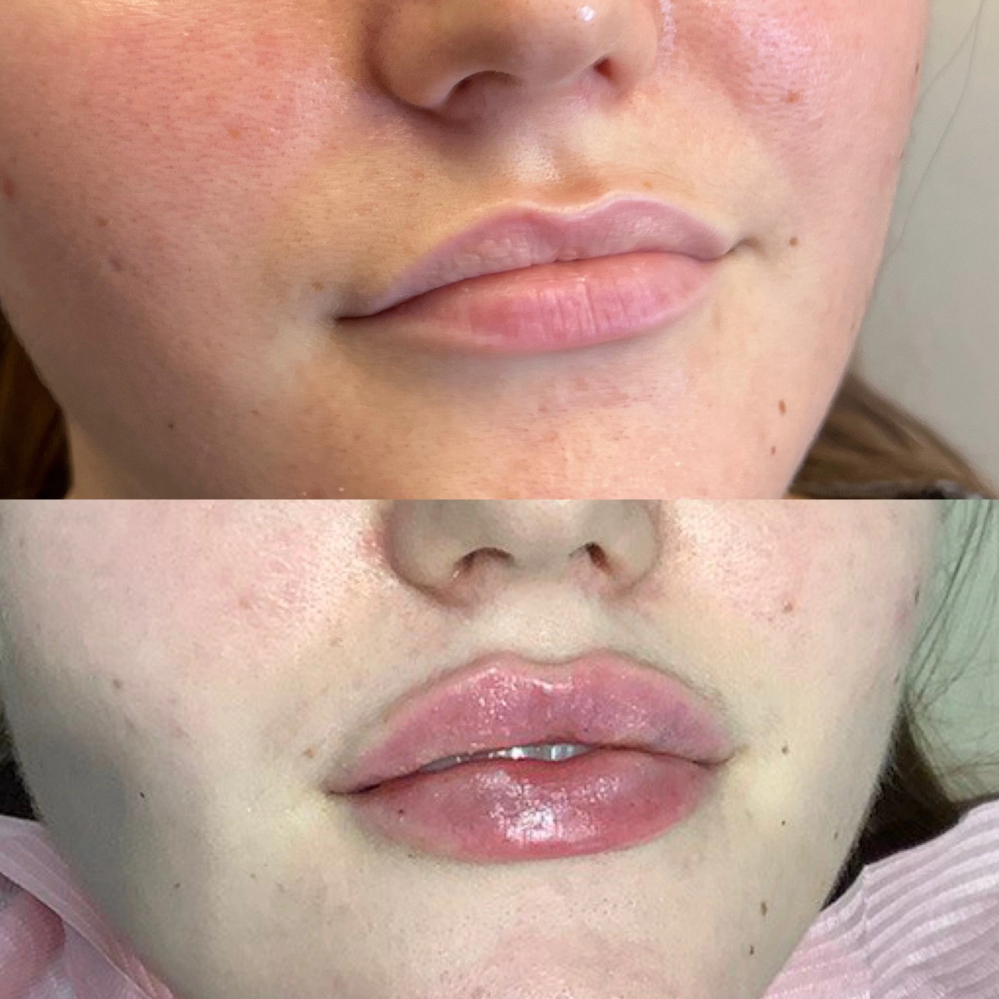 lips-before-after-two-eg-aesthetic-service-in-mayfield-heights-oh