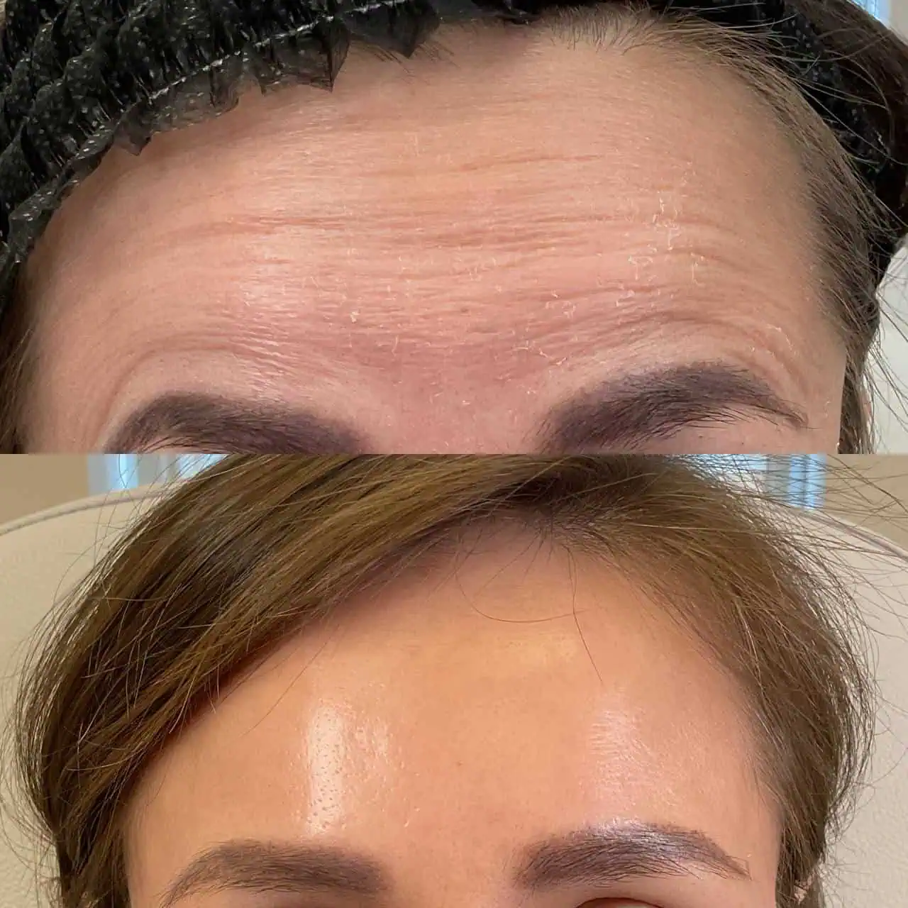 wrinkle-relaxer-before-after-eight-eg-aesthetic-service-in-mayfield-heights-oh