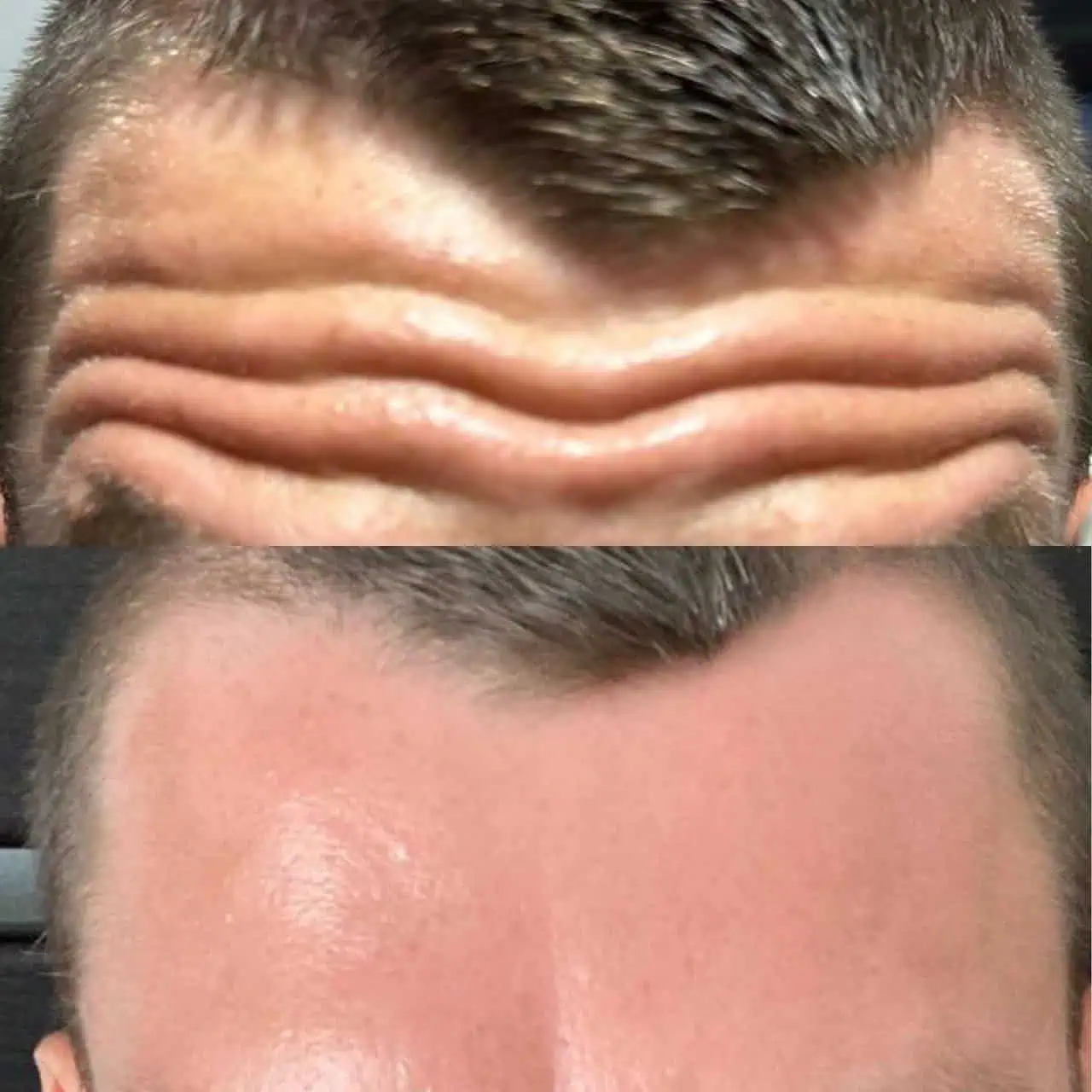 wrinkle-relaxer-before-after-five-eg-aesthetic-service-in-mayfield-heights-oh