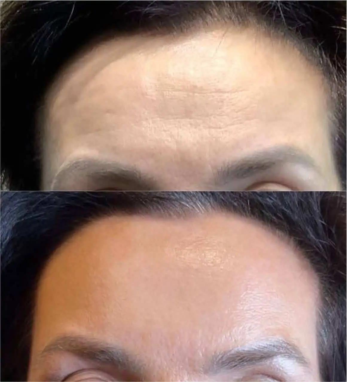 wrinkle-relaxer-before-after-one-eg-aesthetic-service-eg-aesthetic-service-in-mayfield-heights-oh