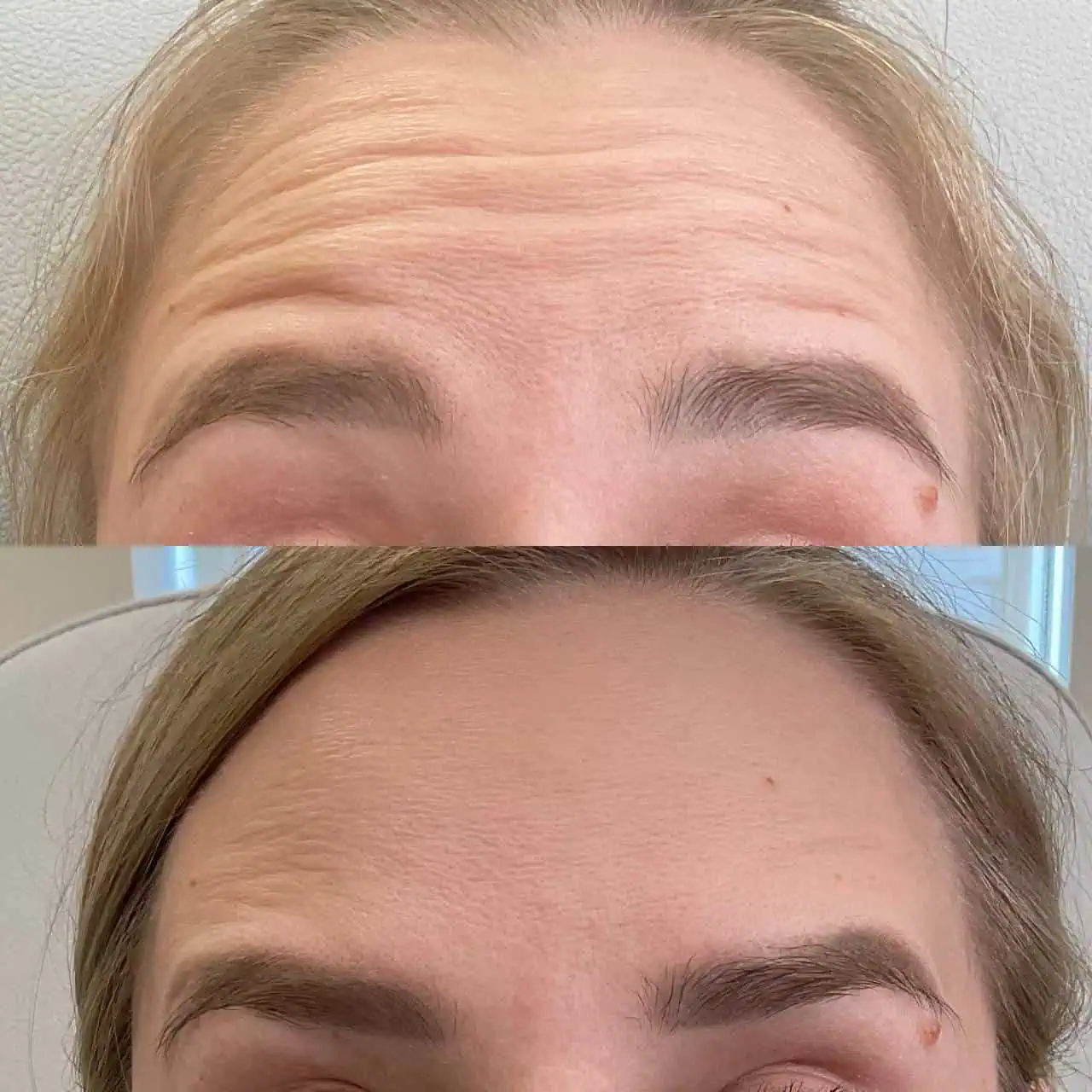 wrinkle-relaxer-before-after-seven-eg-aesthetic-service-in-mayfield-heights-oh