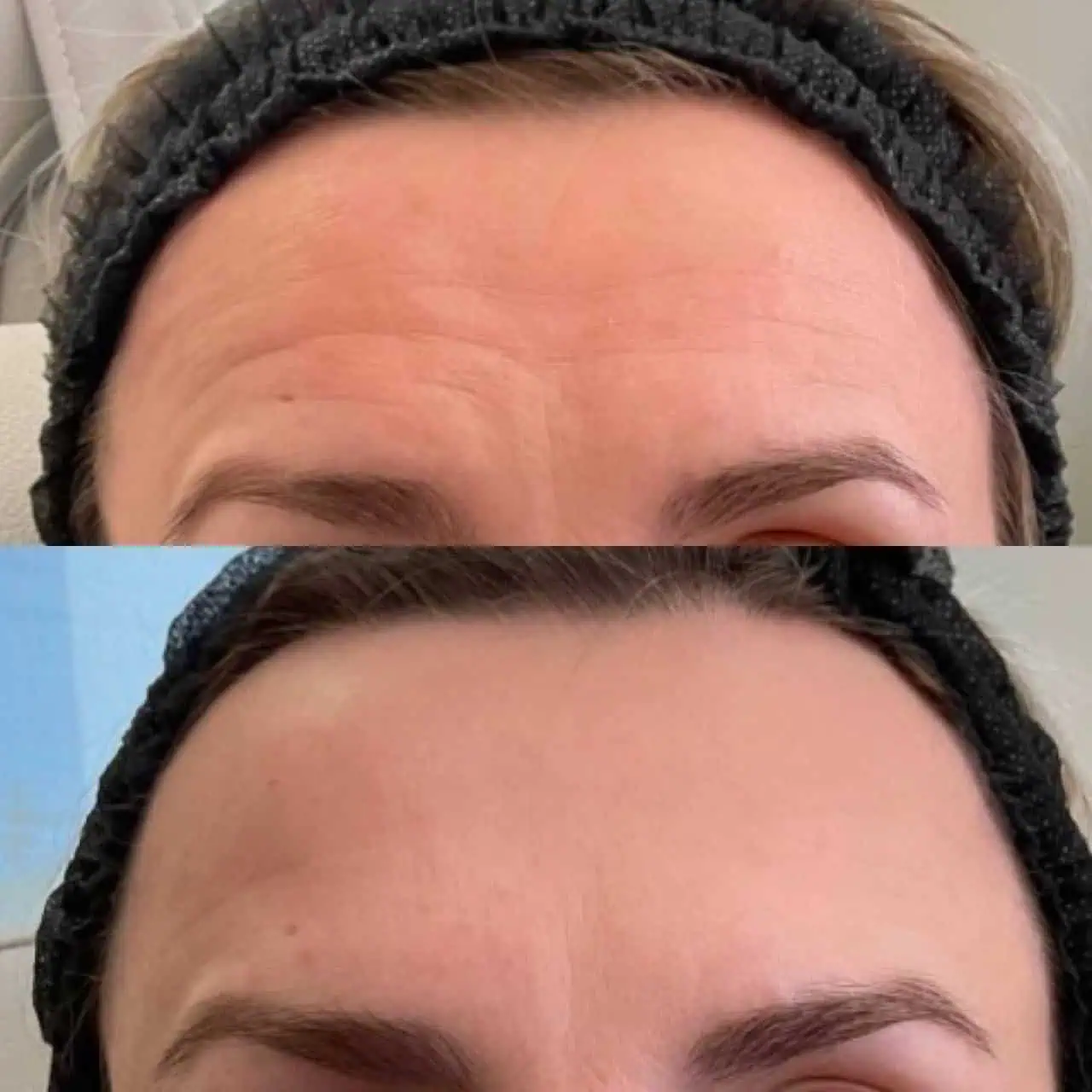 wrinkle-relaxer-before-after-six-eg-aesthetic-service-in-mayfield-heights-oh