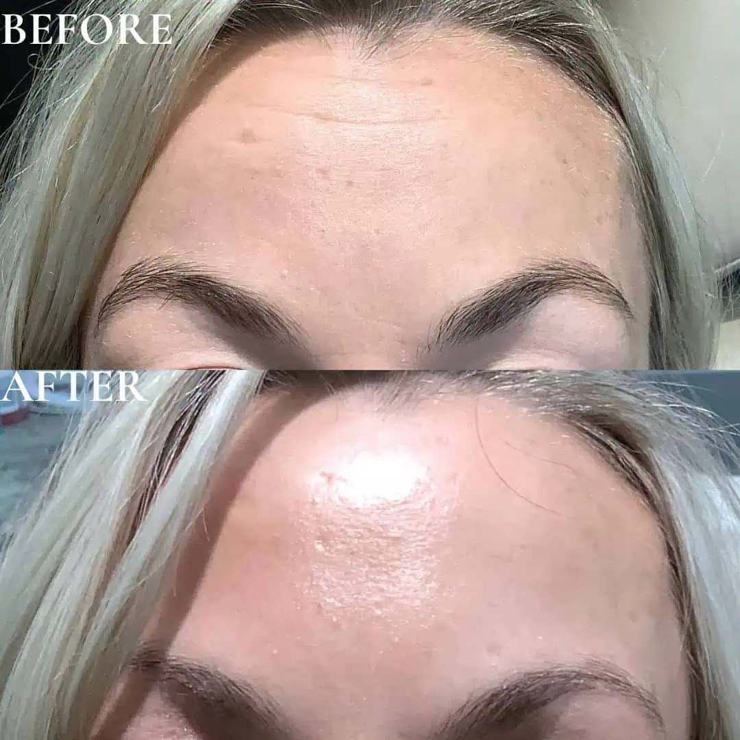 wrinkle-relaxer-before-after-three-eg-aesthetic-service-in-mayfield-heights-oh