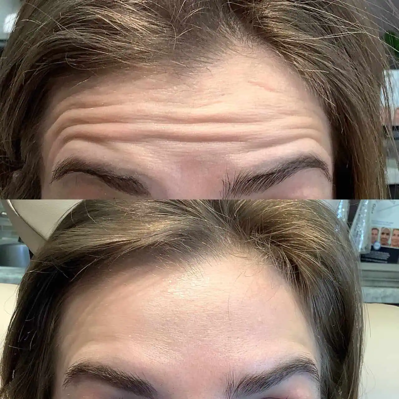 wrinkle-relaxer-before-after-two-eg-aesthetic-service-in-mayfield-heights-oh