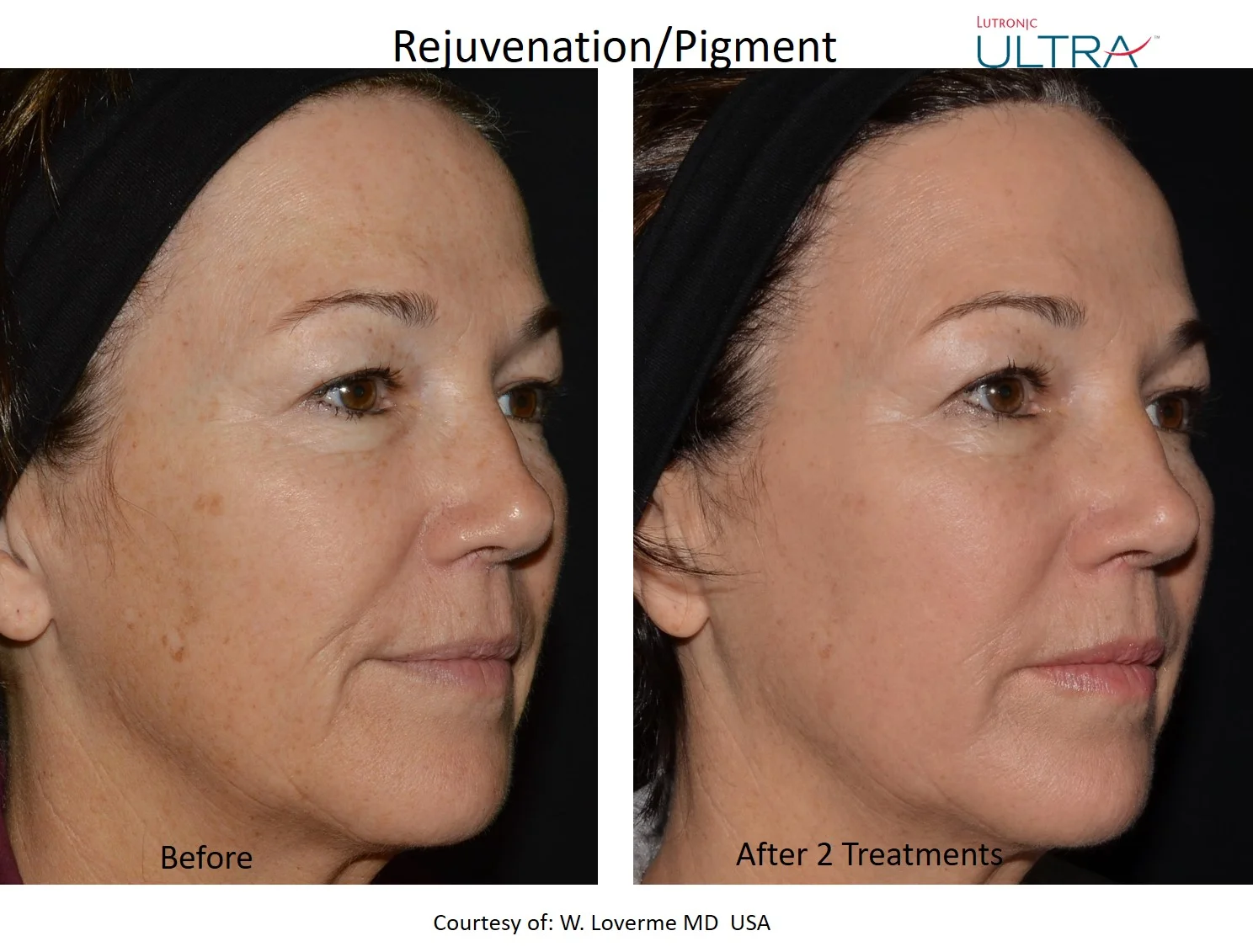 Before and after 2 LaseMD treatments for skin rejuvenation and pigment correction, courtesy of W. Loverme MD USA