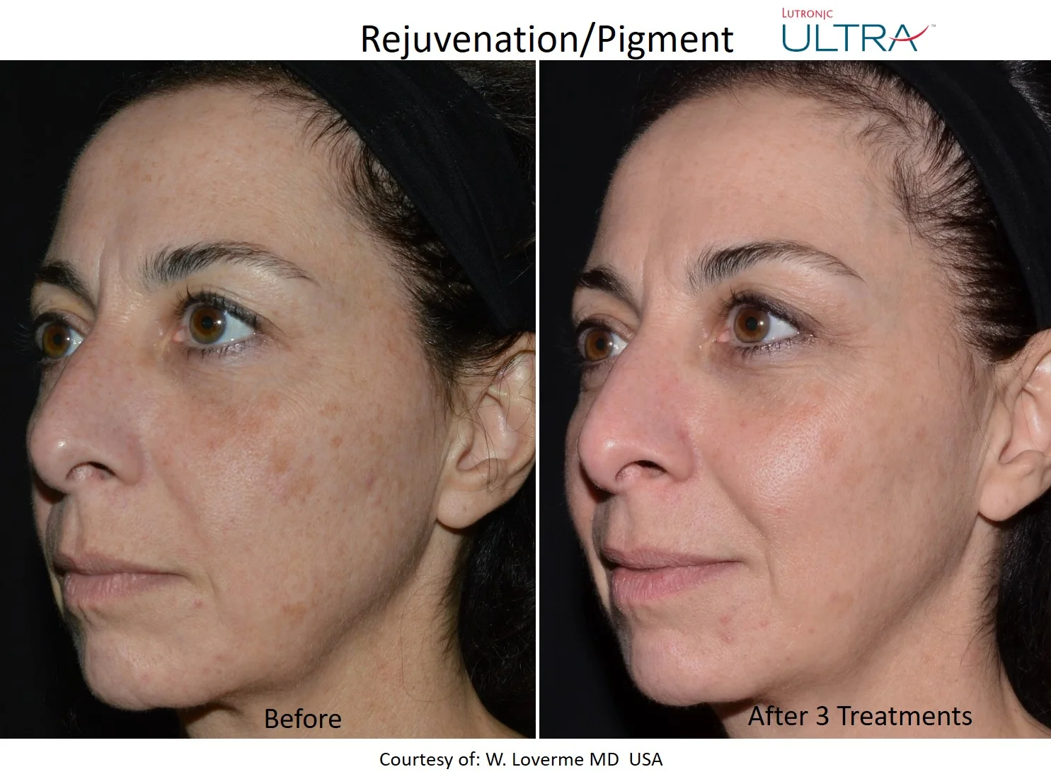 Before and after 3 LaseMD treatments for skin rejuvenation and pigment correction, courtesy of W. Loverme MD USA